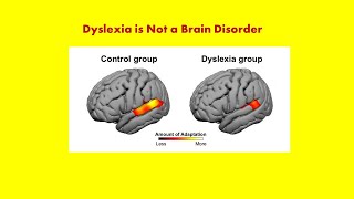 Dyslexia Some Background Information Andrew P Johnson PhD [upl. by Boudreaux448]