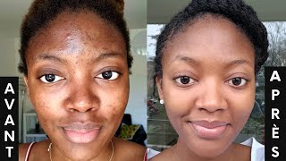 COMMENT ELIMINER LES BOUTONS SUR LE VISAGE [upl. by Yesima]