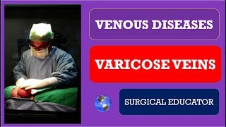 VARICOSE VEINS How To DIAGNOSE amp TREAT Venous Diseases [upl. by Leuamme]