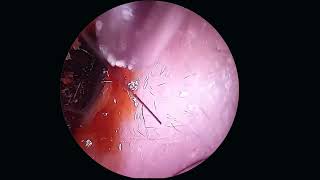 Sloughy Pus Ear Infection Cleaned [upl. by Anrahc]