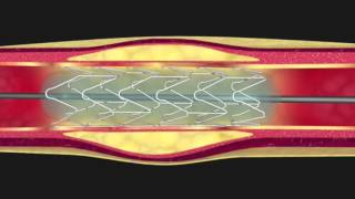 Langioplastie coronaire [upl. by Aseeram]