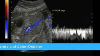 MED2000ECO Persistenza della Vena Ombelicale Destra [upl. by Anytsyrk]