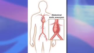 Risks and Benefits of Endovascular Abdominal Aortic Aneurysm Repair EVAR [upl. by Calida]