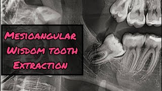 Mesioangular Wisdom Tooth Extraction StepbyStep [upl. by Emmi]