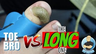 PERMANENT REMOVAL OF A THICK DEFORMED RAMS HORN TOENAIL [upl. by Meyers]