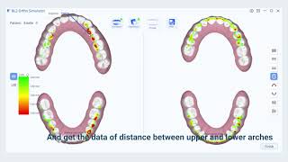 Intraoral Scanner New Function——Orthodontic Simulation [upl. by Nolasba]