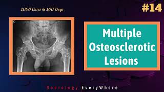 Multiple osteosclerotic lesions  Radiology  1000 cases in 100 days  video 14 [upl. by Gal]