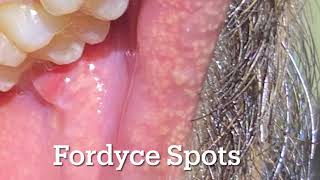 Fordyce Spots white yellow bumps over lips and cheek Should I worry [upl. by Entwistle]