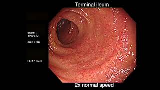 DEEP BACKWASH ILEITIS AND ULCERATIVE COLITIS [upl. by Trilby]