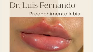 PREENCHIMENTO LABIAL [upl. by Joshuah]