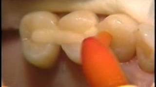 Posterior Periodontal Splint [upl. by Rudich]