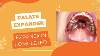 Palate Expansion Complete Treating Idiopathic Condylar Resorption [upl. by Repard]