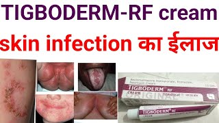 Tigoderm rf creambeclomethasone dipropionate econazole neomycin cream uses benifits in hindizolef [upl. by Nosdrahcir]