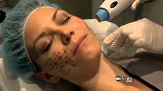 More Young Woman Try to Beat Wrinkles With Preventive Botox Thermage Treatments  ABC News [upl. by Lang]