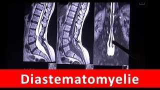 Diastematomyelie  Magnetresonanztomographie  by Radiologie TV [upl. by Garson]