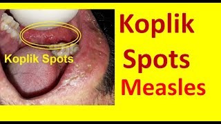 Koplik Spots in Measles [upl. by Moguel]