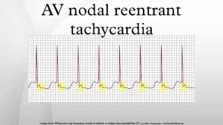 AV nodal reentrant tachycardia [upl. by Tabber]