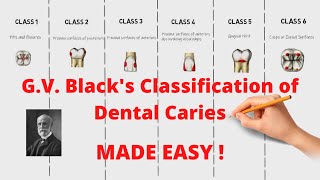 GV Blacks Classification of Dental Caries Quick and Complete Revision [upl. by Kruter]