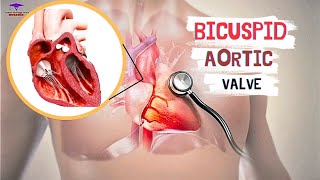 Bicuspid Aortic Valve  cardiology [upl. by Adnauqaj629]