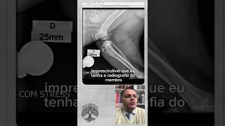 FRATURA POR AVULSÃO DO NÚCLEO DE OSSIFICAÇÃO SECUNDÁRIO DA TUBEROSIDADE TIBIAL [upl. by Oiled]