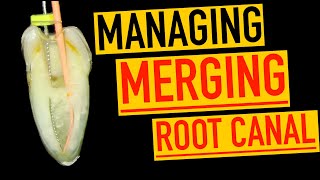 Managing a Joining root canal  4K Resolution [upl. by Ahselak]