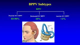 BPPV  Preliminary Insights [upl. by Sterrett]