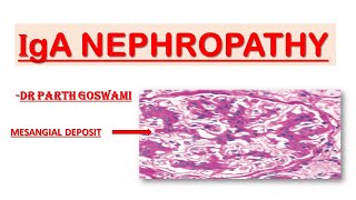 IgA Nephropathy  Simplified Explanation [upl. by Eissoj]