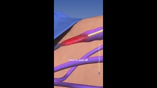 Radiofrequency ablation for vein treatments [upl. by Dallman750]