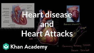 Heart disease and heart attacks  Miscellaneous  Heatlh amp Medicine  Khan Academy [upl. by Navap]