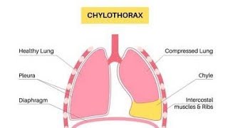 Chylothorax Accumulation of Lymphatics in pleural space  Causes Symptoms Diagnosis Treatment [upl. by Suollecram]