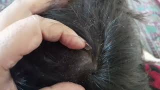 Dandruff scratching black removal scalp asmr dandruff scratching black removal scalp asmr [upl. by Eidoow]