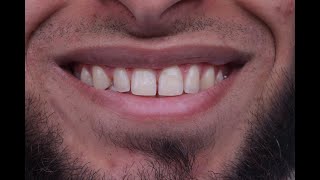 Multiple diastema closure with composite resin [upl. by Nwahc]