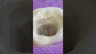 TOOTH CAVITY restoration rootcanal shorts [upl. by Lletnuahs180]