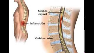 Que es Mielitis Transversa Indicaciones en debilidad en pierna [upl. by Sorvats]