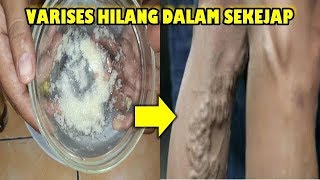 Cara Menghilangkan VARISES Dengan Cepat Dan Alami VARISES Hilang Dalam 3 Hari Dengan Resep Ini [upl. by Keisling]