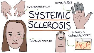 Systemic Sclerosis and Scleroderma Visual Explanation for Students [upl. by Aztilay]