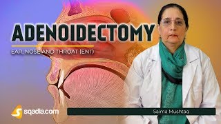 Adenoidectomy  Indications  ENT Video Lectures  Medical Education  VLearning [upl. by Postman]