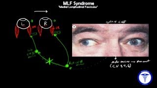 MLF syndrome  Internuclear Ophthalmoplegia MADE EASY [upl. by Erskine]