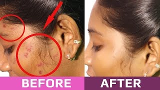 Tips to Remove Pimples Overnight  Beauty Tips in Tamil [upl. by Hun]