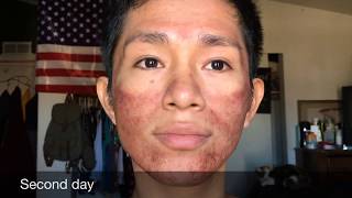 Recovering from Microneedling Acne scars treatment [upl. by Whitford468]