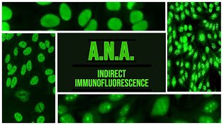 ANA  Antinuclear Antibody  IIF  SLE  Sjogren  RA  CREST [upl. by Htidirem435]