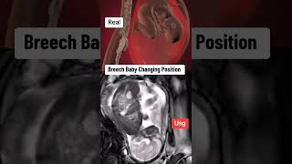 breech baby changing his position inside Womb during ultrasound scan pregnancy babyultrasound [upl. by Aenal]