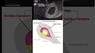 Ultrasound I Early pregnancy I double decidual sac sign DDSS [upl. by Fisk]