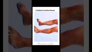 Peripheral Vascular Disease 🗣️   pharmacy shoerts [upl. by Schaumberger]