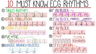 Most Common ECG Patterns You Should Know [upl. by Ojiram481]