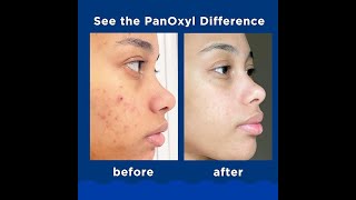 Panicky Acne Foaming Wash Benzoyl Peroxide 10 Maximum Strength Antimicrobial 55 Oz [upl. by Russ623]