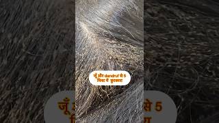 Lice amp Dandruff treatment HomeRemedy lictreatment homeremedy haircaretips [upl. by Eire]