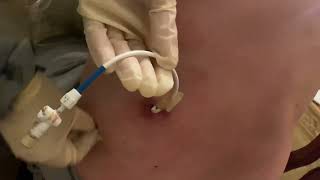 How to clean the area of nephrostomy or nephroureteral drain by Kathy [upl. by Latta]