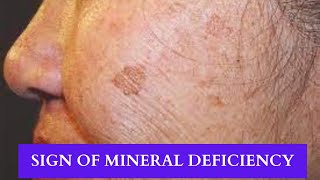 Could This Mineral Deficiency Be The Reason For Your Age Spots [upl. by Sabella]