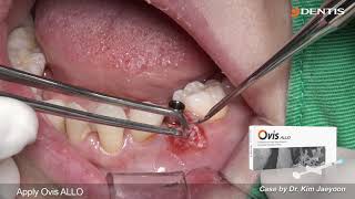 DENTIS Implant Mn premolar immediate placement with SEPTUM DRILL KIT [upl. by Iak979]